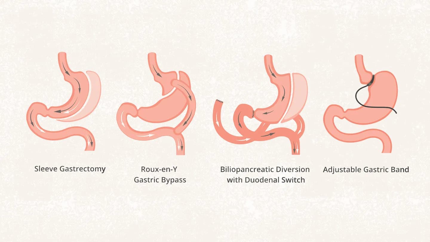 Bariatric surgery