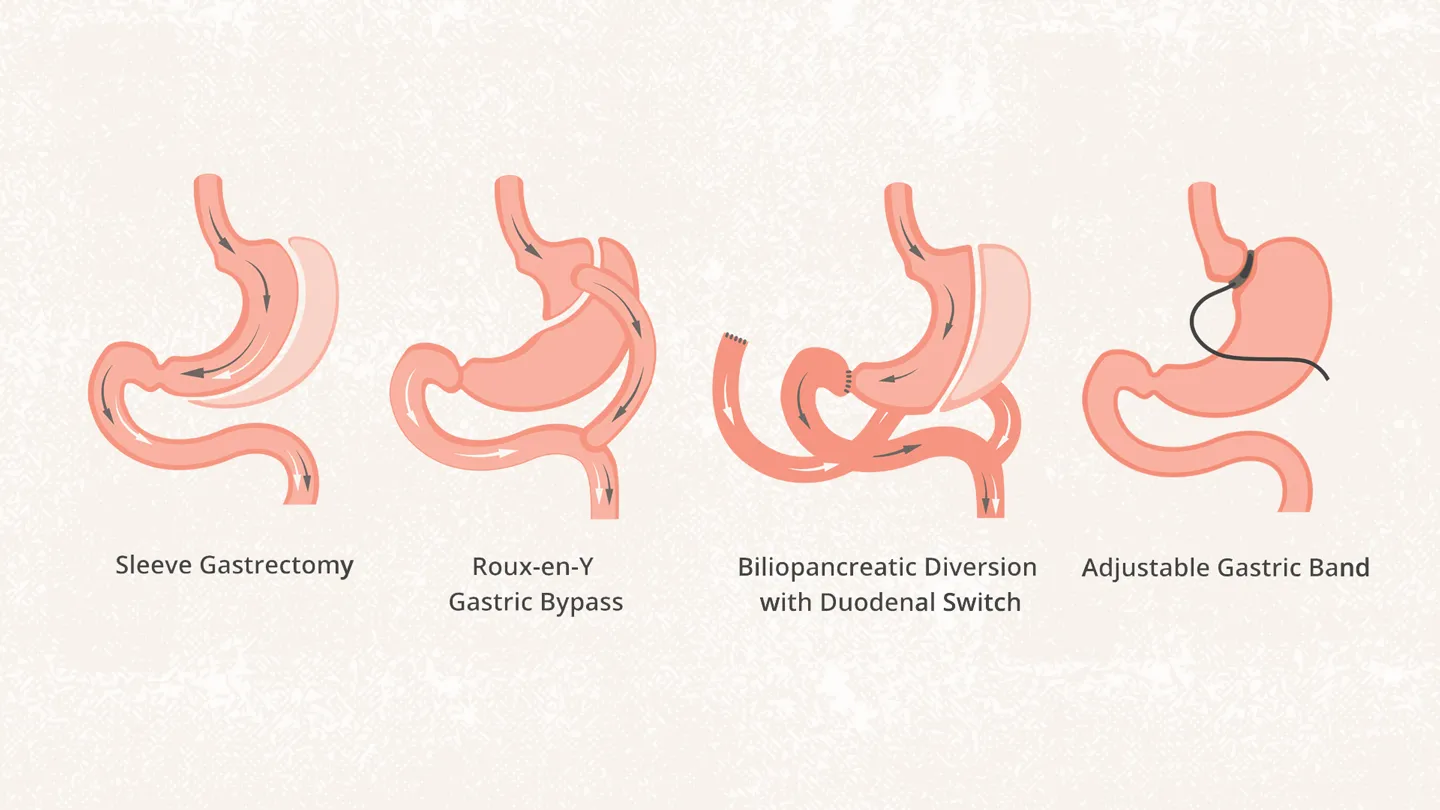 Bariatric Surgery