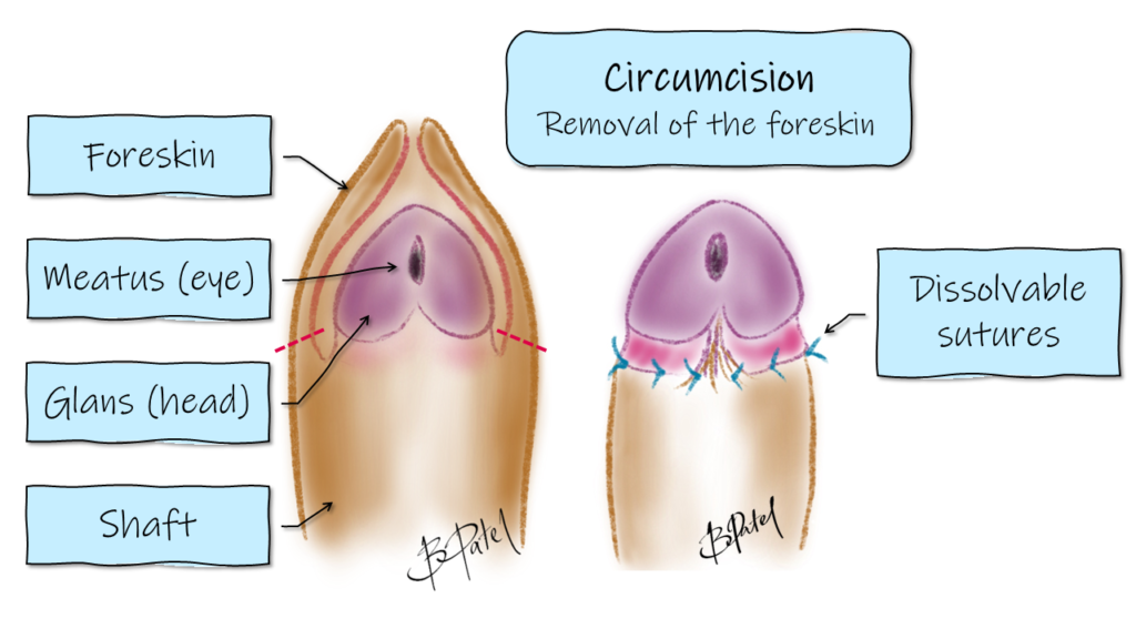 Circumcision