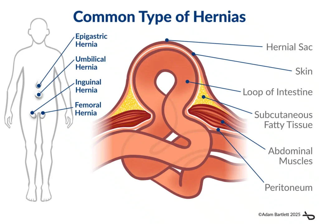 Hernia Treatment