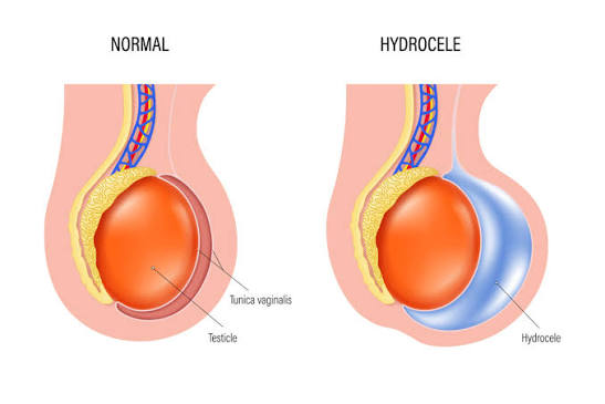 Hydrocele