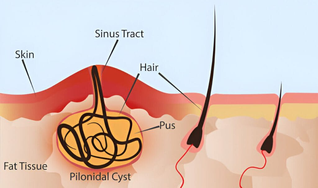 Pilonidal Sinus