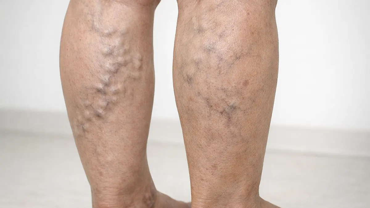 Varicose Veins